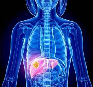 Богатите и бедните страдат от различни видове рак