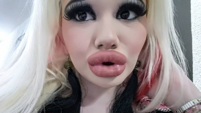 Българска студентка в търсене на мода утрои устните си