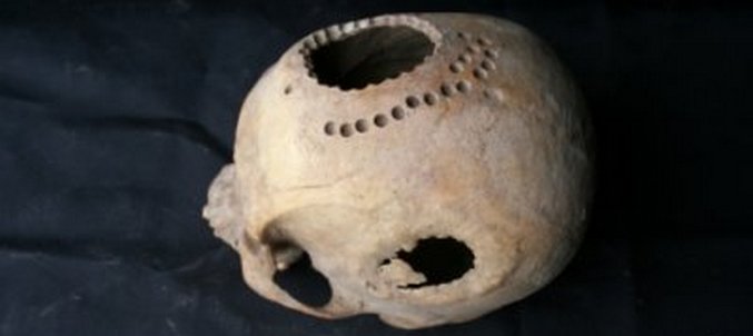 Древните жители на Сибир знаеха как да правят мозъчна операция