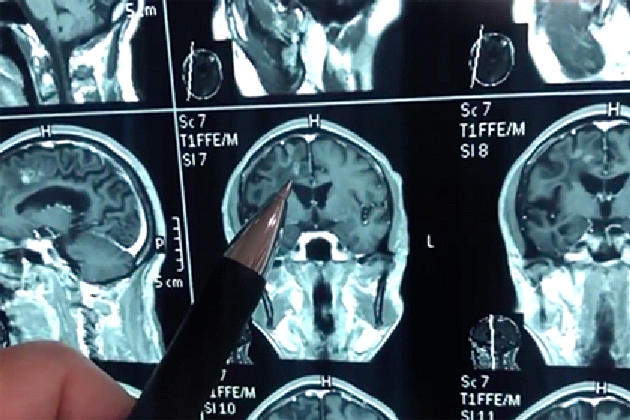 Китаец живееше 30 години с огромен червей в главата.