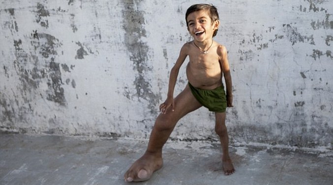 Момче голям крак