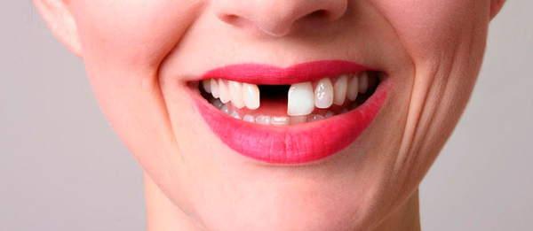 загубил зъб 