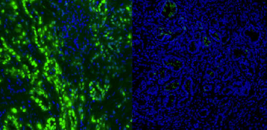 Панкреаса, рак
