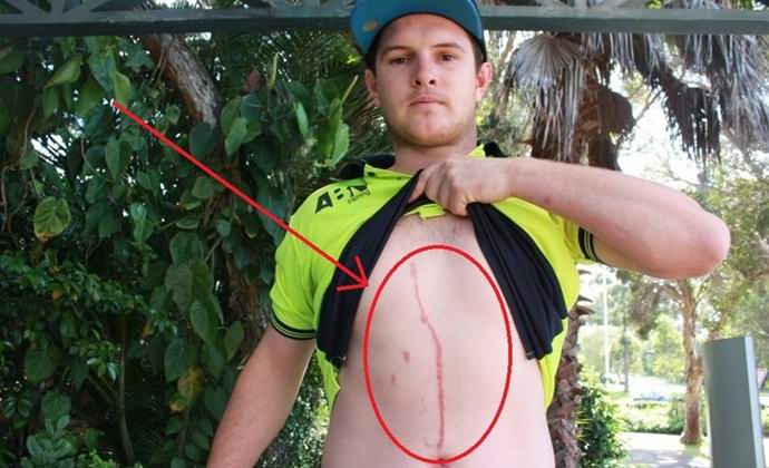Паякът прегриза движение в корема на австралиеца
