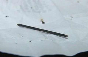 Акупунктурна игла пътува през тялото на 40-годишен мъж