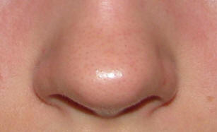 След лечение със стволови клетки, американският нос порасна