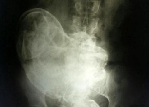 В Бразилия 44-годишна жена носеше мъртво бебе в себе си.