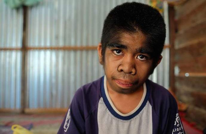 Космено момче със синдром на върколак отказва лечение