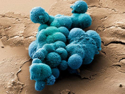 Ракови клетки на панкреаса, които се опитват да образуват обемна структура. (C нимка noindexa target = _blank href = http: //www.corbisimages.comDr. Stanley Flegler / a / noindex.)